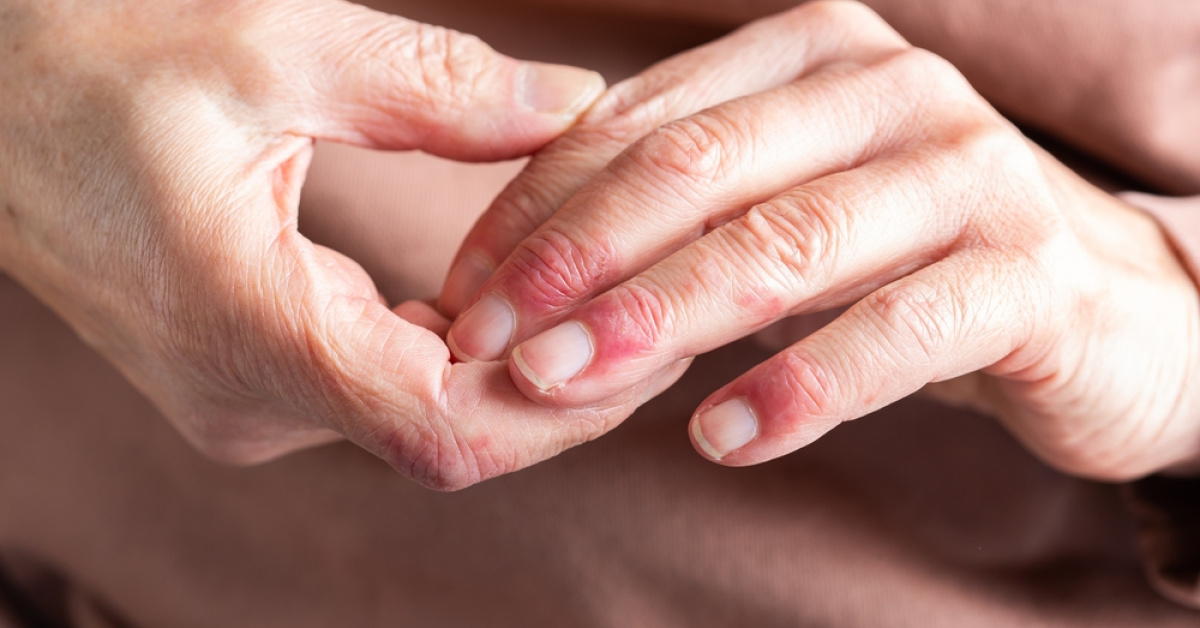 Cildimdeki Hikaye Projesiyle Atopik Dermatit Sanatla Görünür Oldu